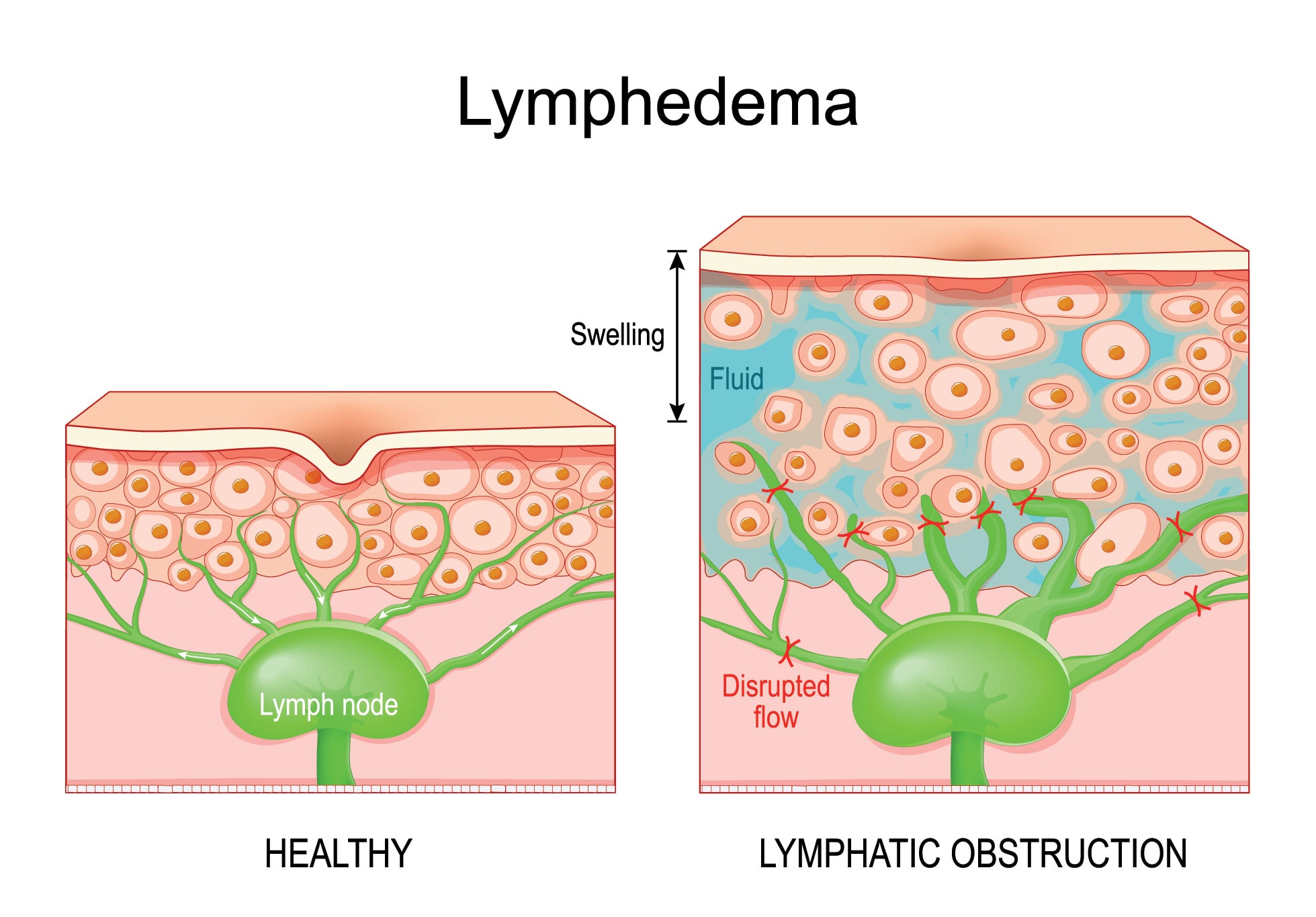 infograph for lymphedema