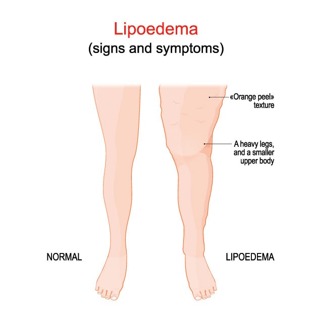 infograph about lipoedema